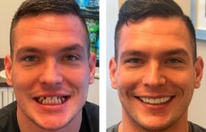 Implantes dentales - Antes y Después implantes dentales antes después